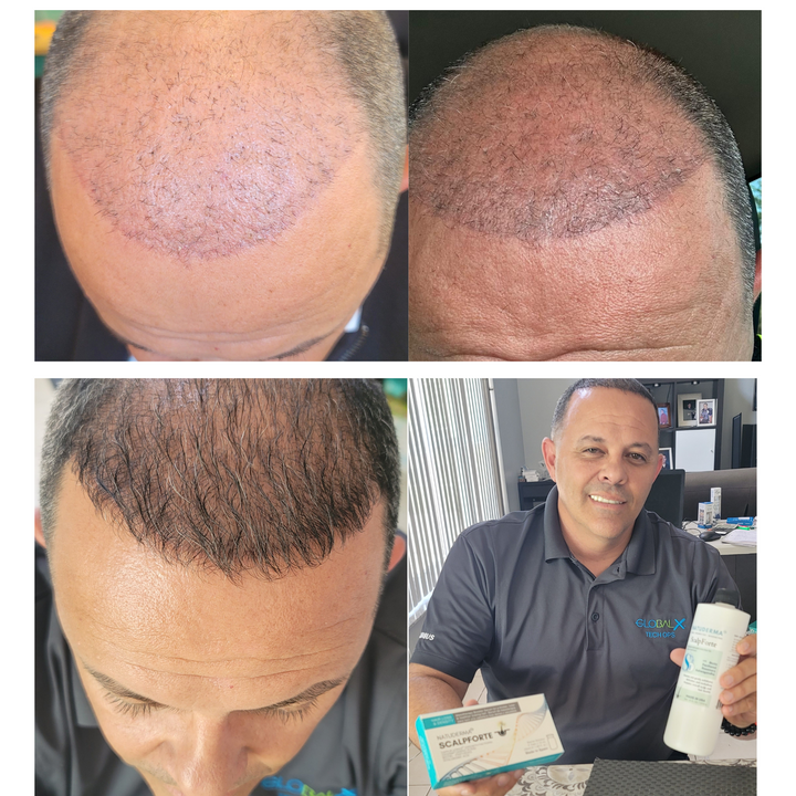 Natuderma Hair Loss Treatment Booster Scalpforte, before and after photo with Scalp Exosomes