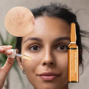 Tranexamic Acid for Hyperpigmentation, Dark Spot and Melasma Reduction. Hyperpigmentation