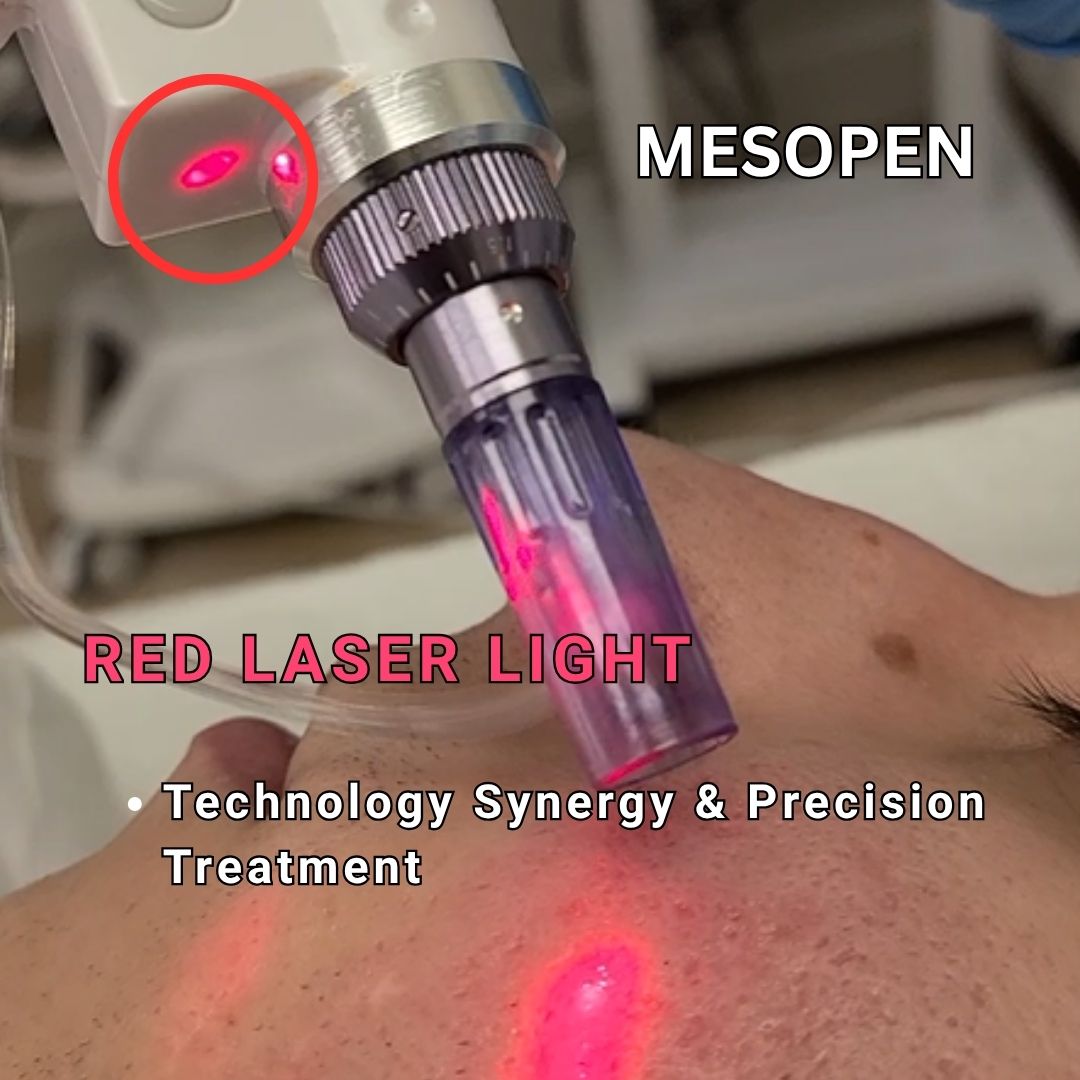 Microneedling pen with Red laser light treatment with MESOPEN device on skin