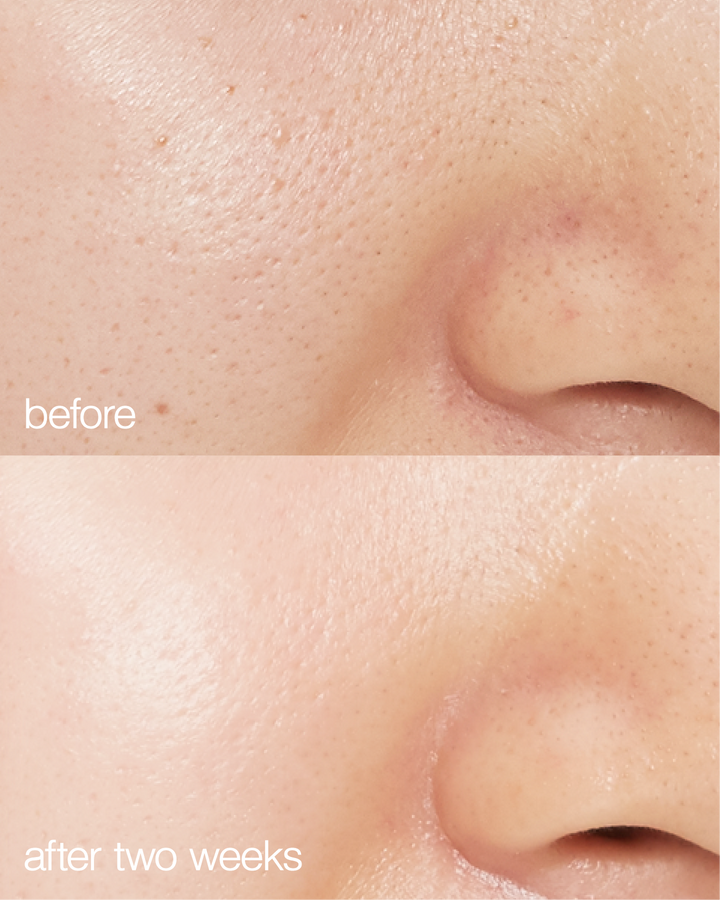Before and after comparison of skin texture on a person's nose.