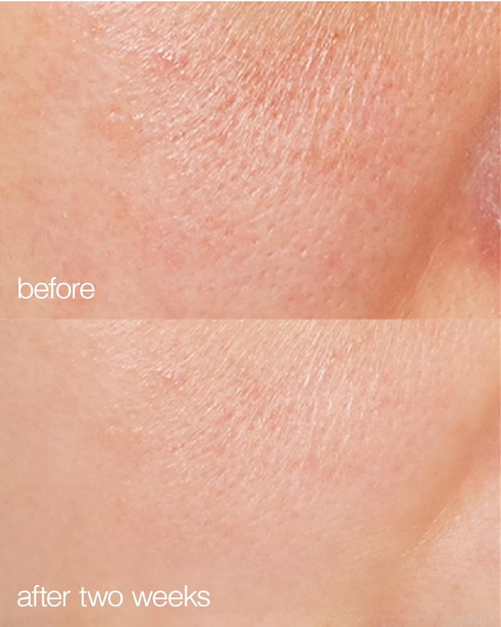 Before and after comparison of skin texture with 'before' showing more visible pores and 'after two weeks' showing smoother skin.