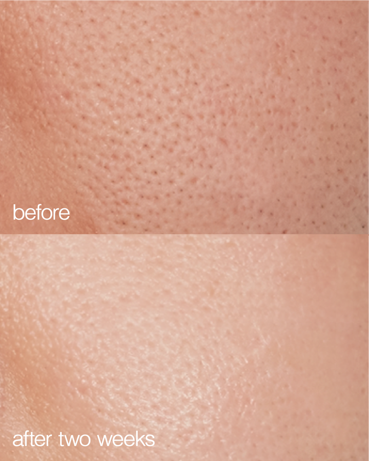 Before and after comparison of skin texture with 'before' showing pores and 'after two weeks' showing smoother skin.