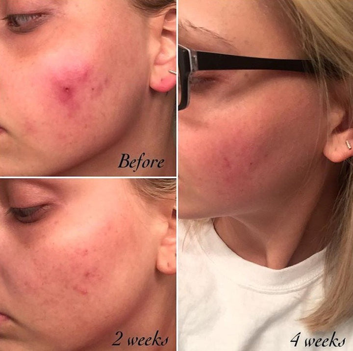 Before and after comparison of a person's face with acne, showing improvement over time.