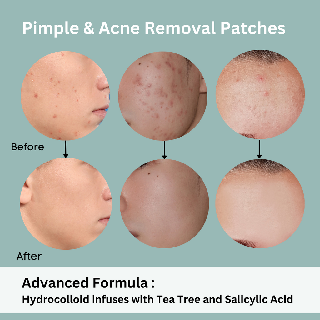 Pimple patch , hydrocolloid acne patches , salicylic acid pads . Natuderma acne pimple patches with tea tree and salicylic acid