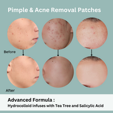 Pimple patch , hydrocolloid acne patches , salicylic acid pads . Natuderma acne pimple patches with tea tree and salicylic acid