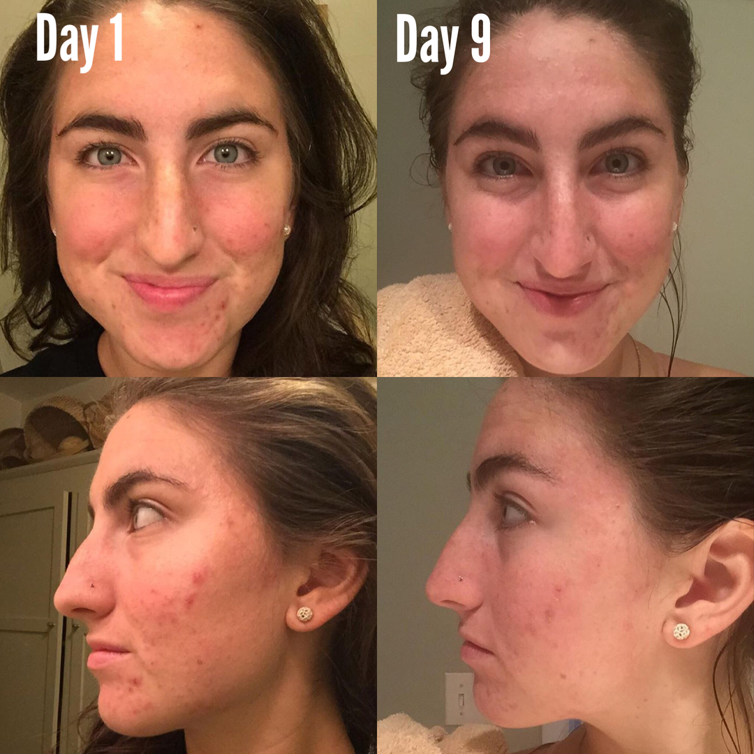 Before and after comparison of a woman's face over 9 days showing skin improvement.