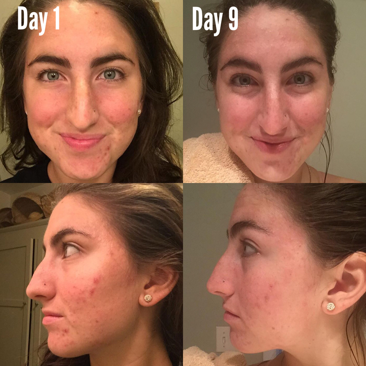 Before and after comparison of a woman's face over 9 days showing skin improvement.