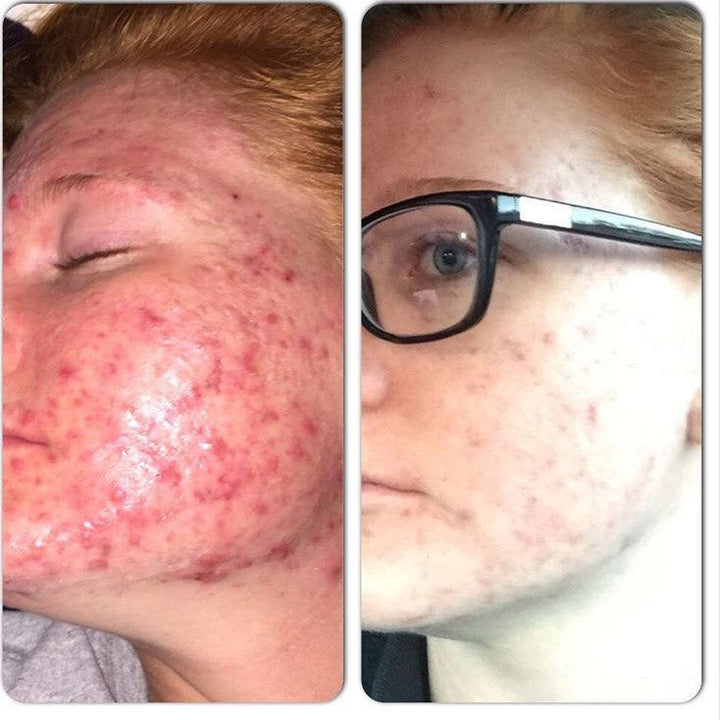 3-Step Acne System - Facial Cleanser, Toner and Moisturizer for Oily Skin