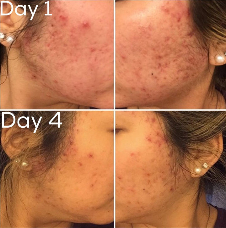 Before and after comparison of acne on a person's face over four days.