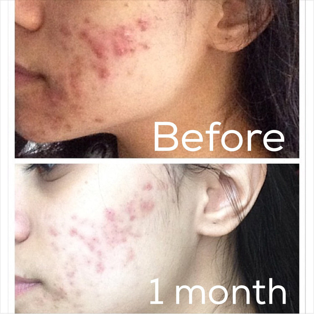 3-Step Acne System - Facial Cleanser, Toner and Moisturizer for Oily Skin