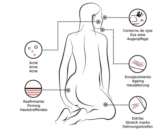 Institute BCN Hyaluronic Acid application areas diagram: eye area, acne, ageing, firming, stretch marks — multilingual illustration showing body treatment zones